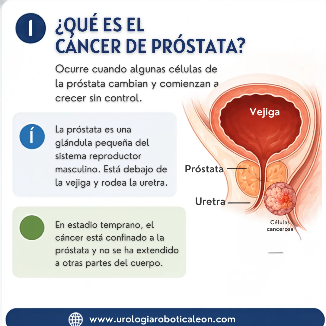 Infografía: qué es el cáncer de próstata — células de la glándula prostática que crecen sin control, ubicada debajo de la vejiga